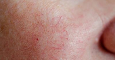R4_opt Facial Telangiectasia