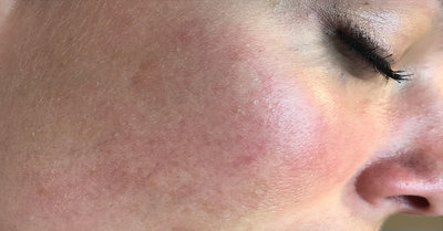 rsz_is_rosacea-treatment